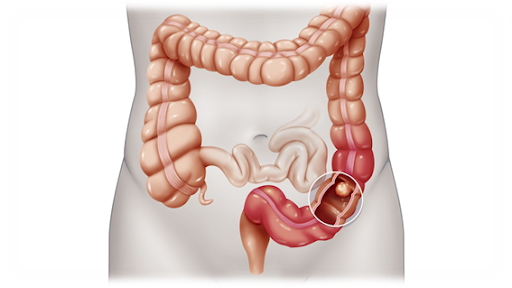 ALIMENTACIÓN PARA CÁNCER DE COLON